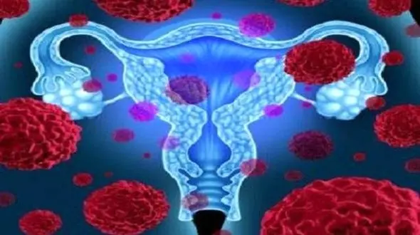 علائم این سرطان زنانه را بشناسید