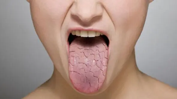 طب سنتی و ارتباطش با خشکی دهان 