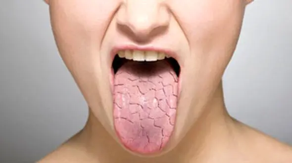 طب سنتی و ارتباطش با خشکی دهان 