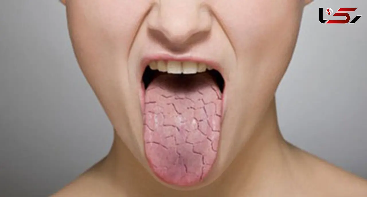 طب سنتی و ارتباطش با خشکی دهان 