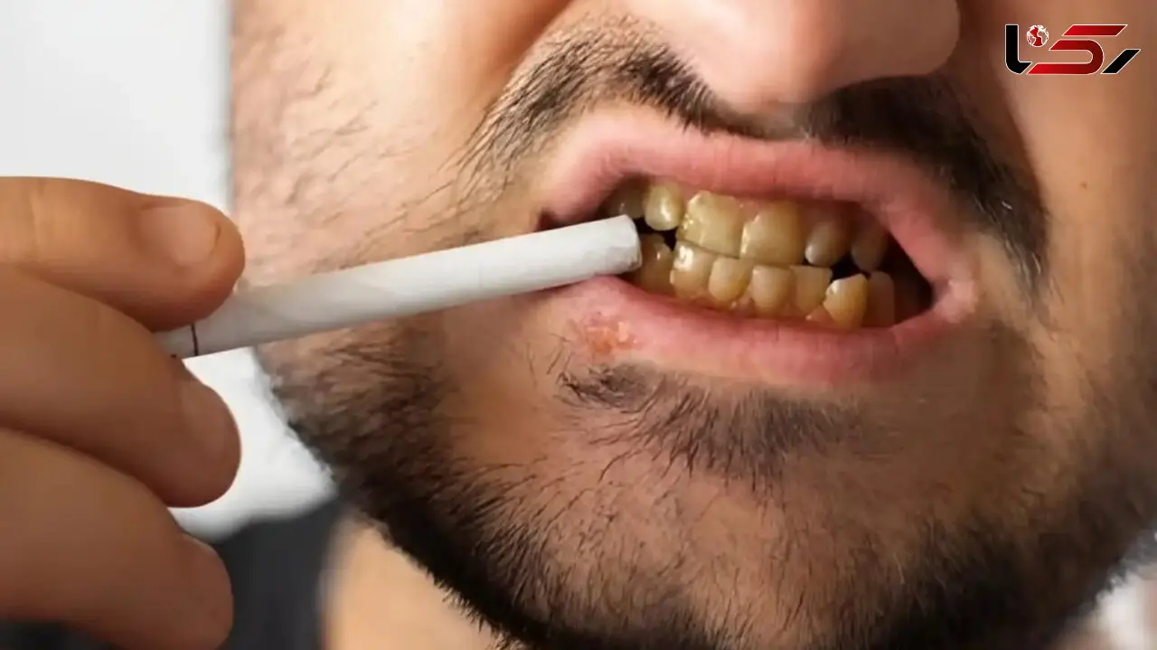 چرا دندان سیگاری‌ ها حتی بعد از جرم‌ گیری هم زرد می‌ ماند؟ / لکه‌ هایی که به ساختار دندان نفوذ می‌ کند