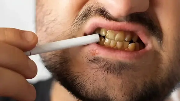 چرا دندان سیگاری‌ ها حتی بعد از جرم‌ گیری هم زرد می‌ ماند؟ / لکه‌ هایی که به ساختار دندان نفوذ می‌ کند