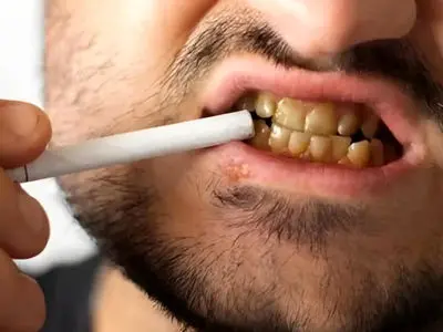 چرا دندان سیگاری‌ ها حتی بعد از جرم‌ گیری هم زرد می‌ ماند؟ / لکه‌ هایی که به ساختار دندان نفوذ می‌ کند