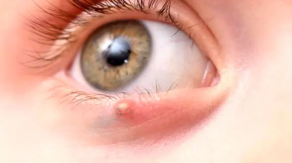 گل مژه چیست؟ / از علائم تا عوارض + درمان