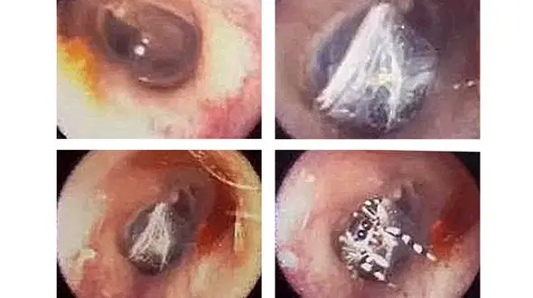 خارج کردن یک موجود از گوش زن جوان + فیلم