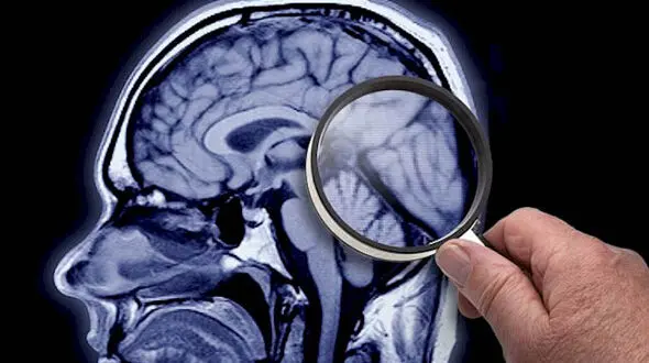 آلومینیوم با آلزایمر ارتباط مستقیم دارد