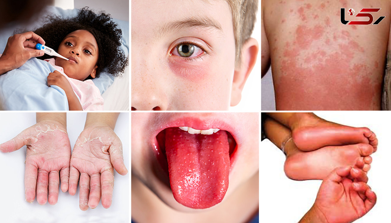 ضایعات پوستی کرونا در کودکان شدیدتر است / به شکل سندرم کاوازاکی بروز پیدا می کند