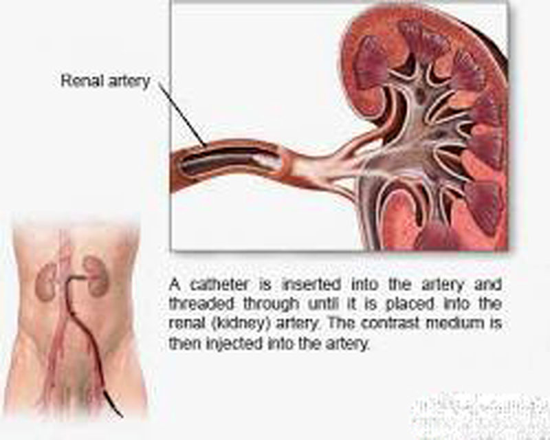 آنژیوگرافی کلیه