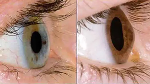 لیست کامل بیماری های چشمی + علت و علائم و درمان