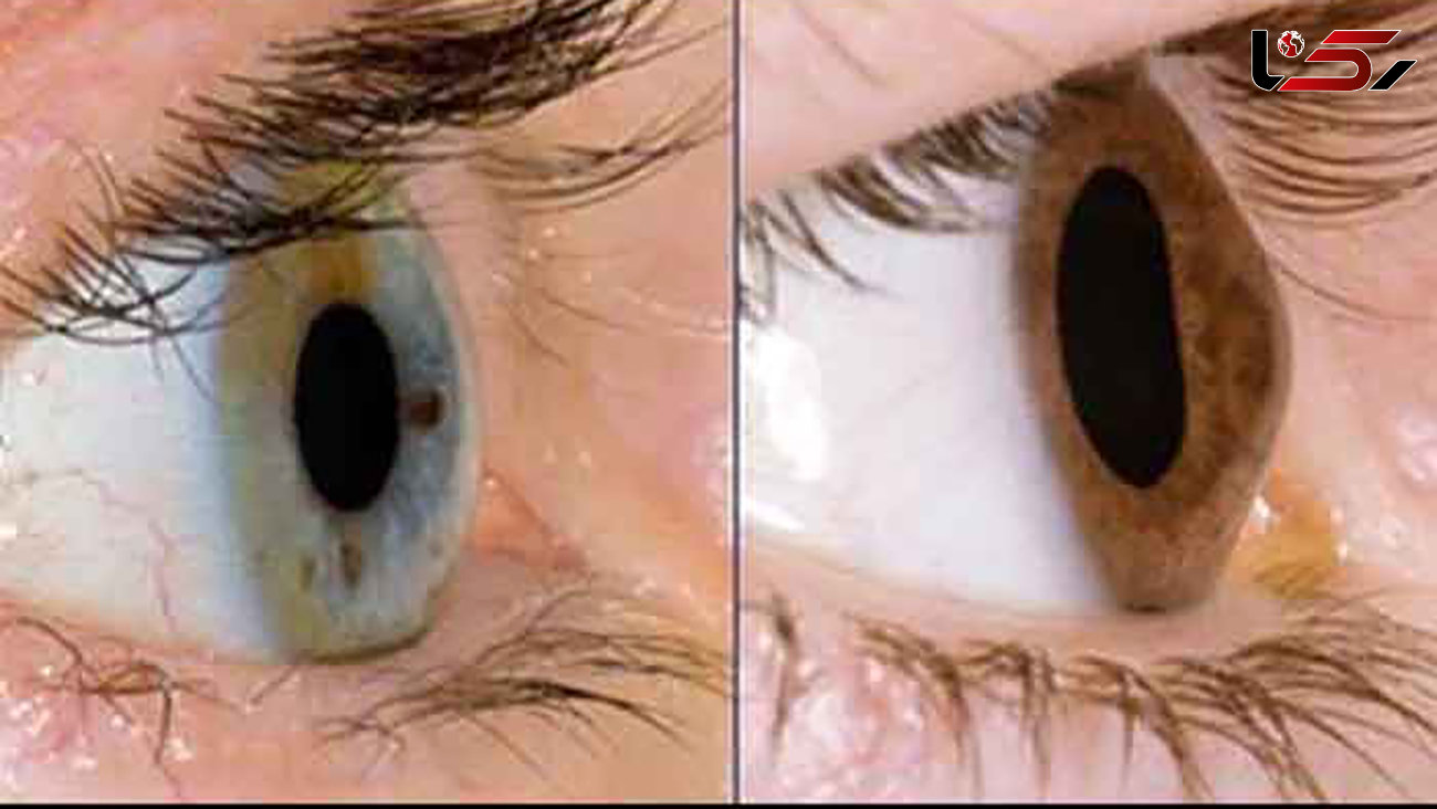 لیست کامل بیماری های چشمی + علت و علائم و درمان