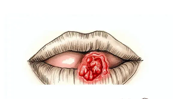 هشدار پزشکی درباره ورم لب هنگام بیدار شدن از خواب
