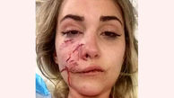 حمله سگ وحشی به خانم مدلینگ / صورت این دختر 19 بخیه خورد +عکس