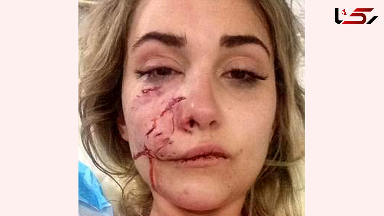 حمله سگ وحشی به خانم مدلینگ / صورت این دختر 19 بخیه خورد +عکس