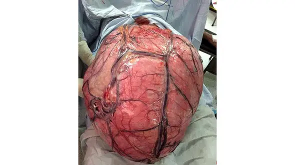بزرگترین تومور تاریخ از رحم زن 40 ساله بیرون کشیده شد + عکس