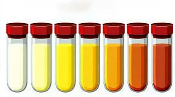 نشانه بیماری از روی رنگ و بوی ادرار 