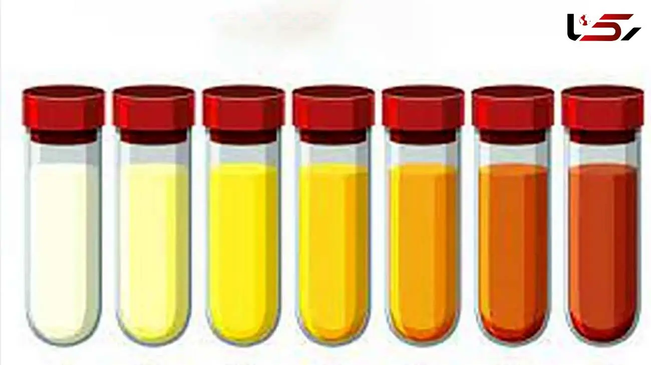 نشانه بیماری از روی رنگ و بوی ادرار 