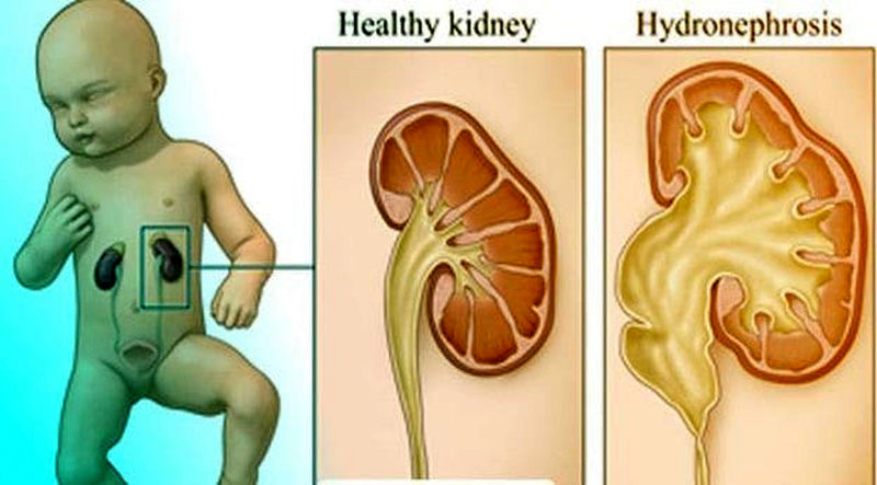 هیدرونفرون کلیه