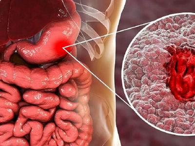 التهاب معده چیست؟