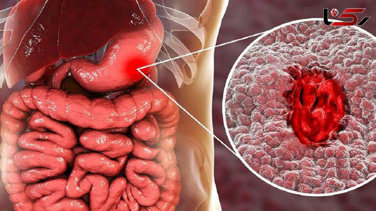 التهاب معده چیست؟ + فیلم