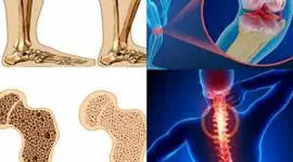 پوکی استخوان چیست؟ + روش های درمانی