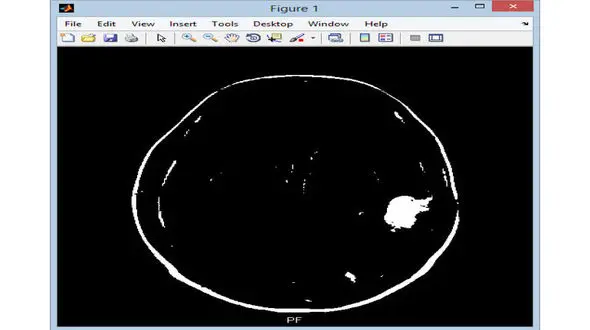 تشخیص تومور با زبان بدن