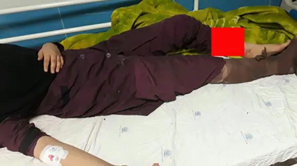 پشت پرده فاجعه در مدرسه دخترانه کوهدشت چه بود؟! / دختری که دیگر دست ندارد ! + عکس