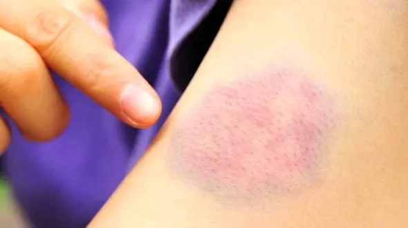 چرا بی دلیل کبود می شویم؟