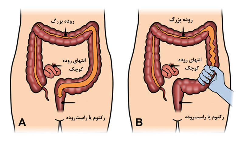 سندرم روده تحریک پذیر