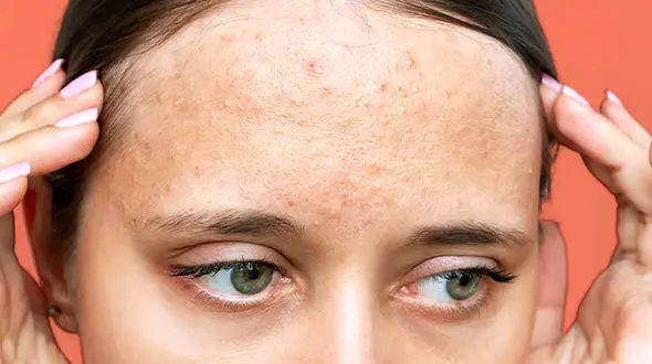 علت جوش پیشانی و راه حل درمانی 