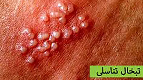 درمان خانگی تبخال تناسلی