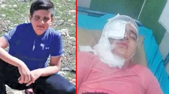 عکس قبل و بعد اسیدپاشی به پسر دانش آموز 11 ساله کرمانشاهی