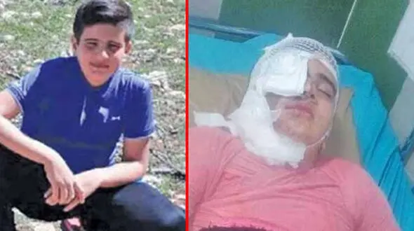 عکس قبل و بعد اسیدپاشی به پسر دانش آموز 11 ساله کرمانشاهی