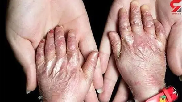بیمه سلامت : بیماری های نادر مشمول بیمه رایگان می شوند