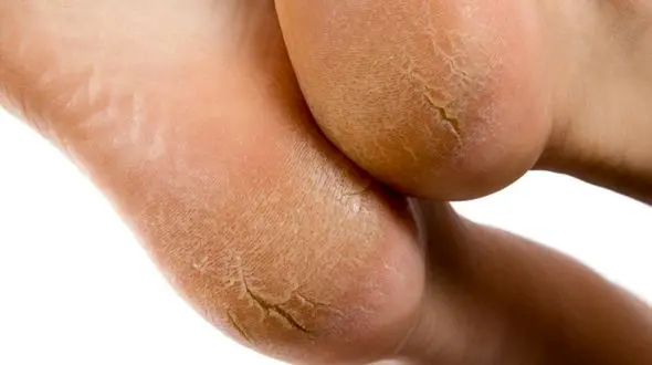 تشخیص انواع بیماری ها از روی شکل پا / پای قرنطینه چیست؟