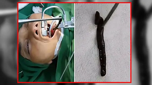 زندگی زالوی زنده در گلوی یک زن/همه وحشت کردند+عکس باورنکردنی