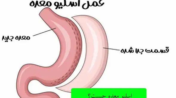 اقدامات قبل از جراحی لاغری چیست؟