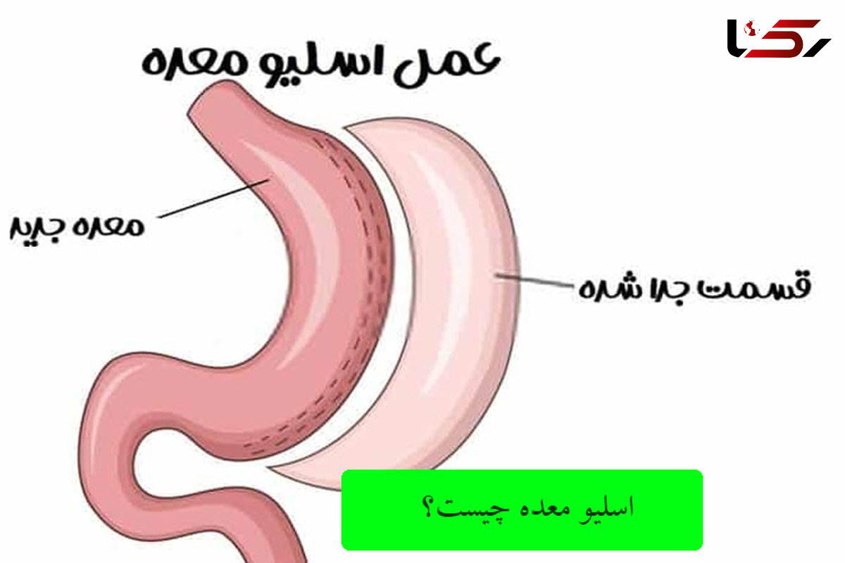 اقدامات قبل از جراحی لاغری چیست؟