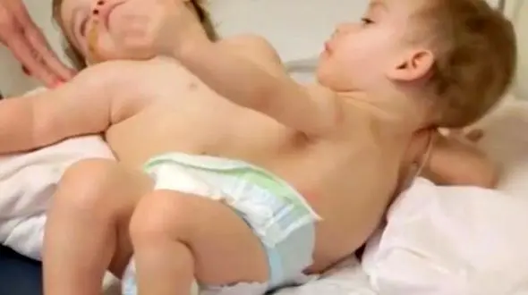 فیلم سخت ترین جراحی جداسازی دوقلوهای به هم چسبیده+عکس