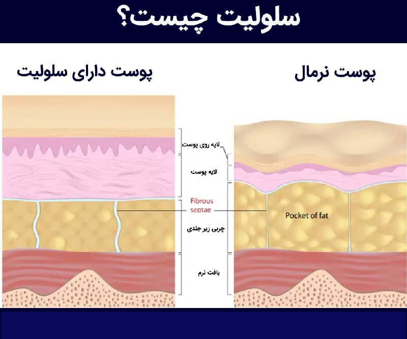 سلولیت و پوست نرمال