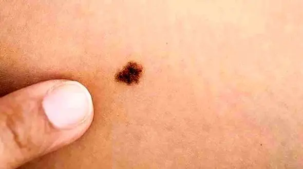 چه خال هایی سرطانی است؟