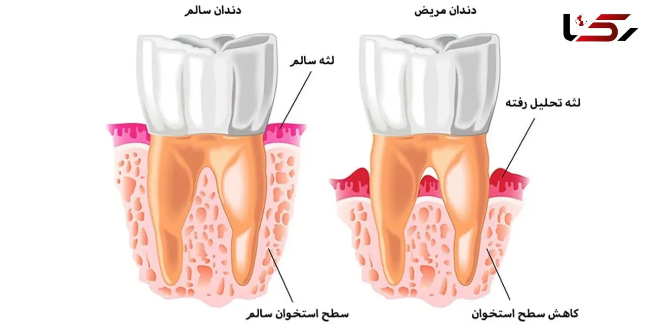 تحلیل لثه چیست