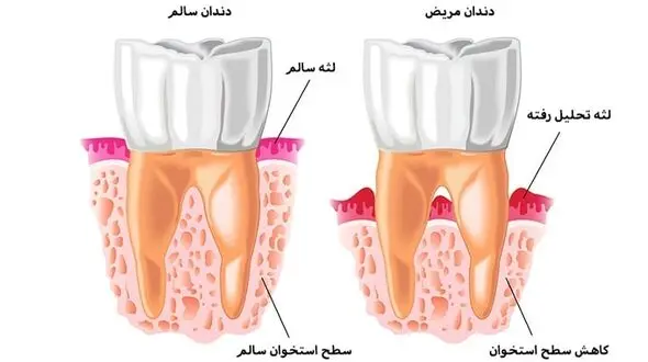 تحلیل لثه چیست