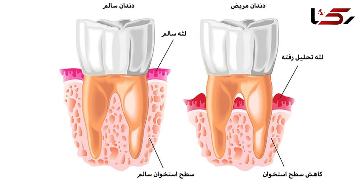 تحلیل لثه چیست