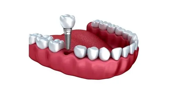 هزینه کاشت ایمپلنت دندان: مقایسه انواع برندهای ایمپلنت 