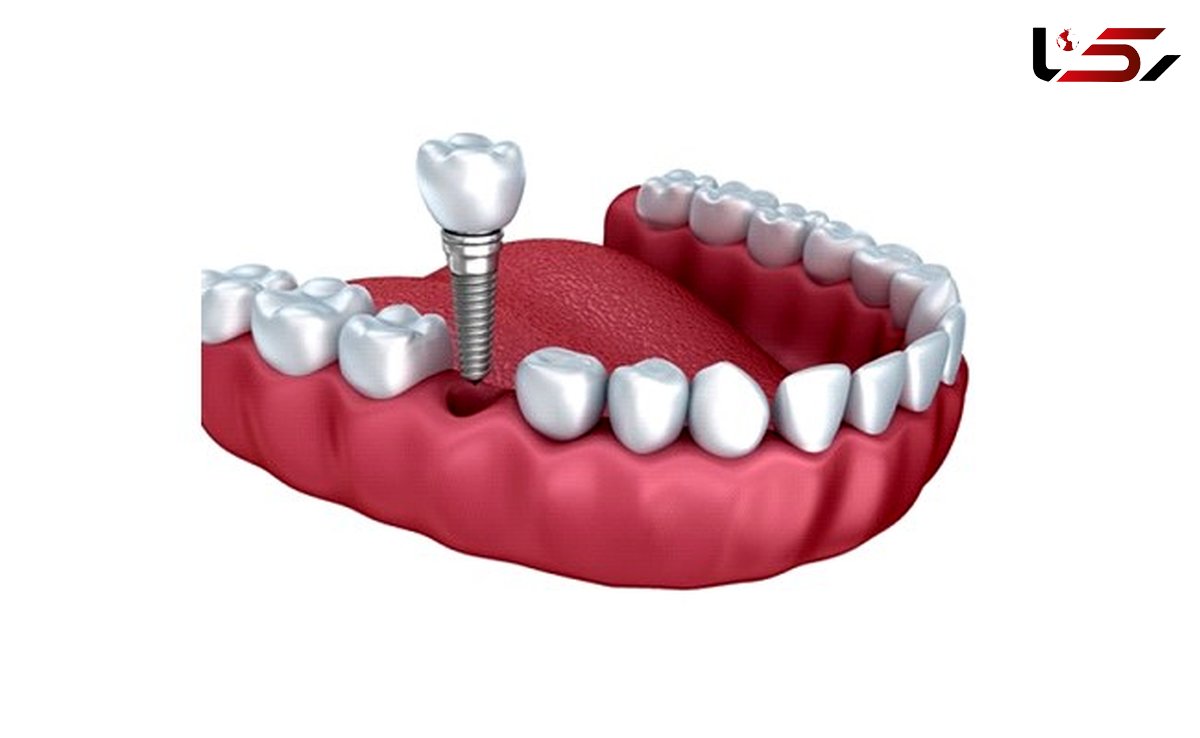 هزینه کاشت ایمپلنت دندان: مقایسه انواع برندهای ایمپلنت 