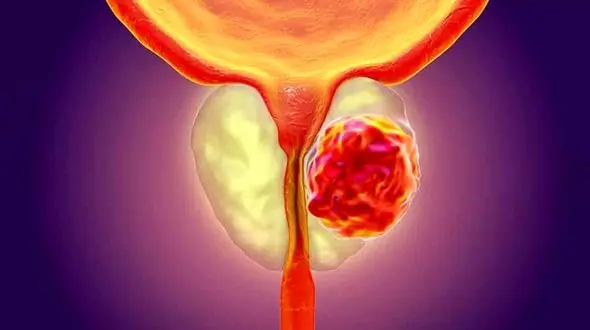 فواید ماساژ پروستات