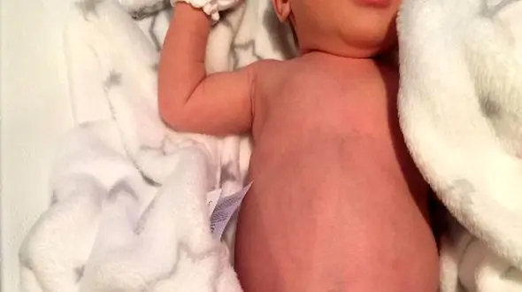 آیا بزرگی شکم نوزاد طبیعی است؟ بررسی دلایل و توصیه‌ ها