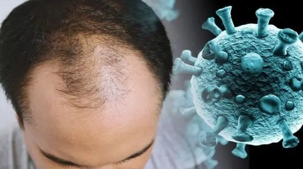آیا پاستیل های میلیونی باعث درمان ریزش مو بر اثر کرونا می شوند؟ / یک متخصص پوست و مو: باور نکنید! 