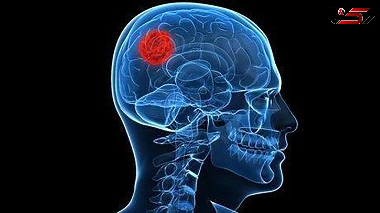  محقق ایرانی به جنگ تومور مغزی رفت