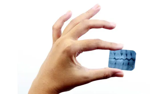 عکس رادیولوژی دندان کمبود ویتامین دی را نشان می دهد